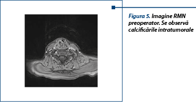 Figura 5. Imagine RMN preoperator. Se observă calcificările intratumorale