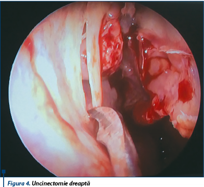 Figura 4. Uncinectomie dreaptă