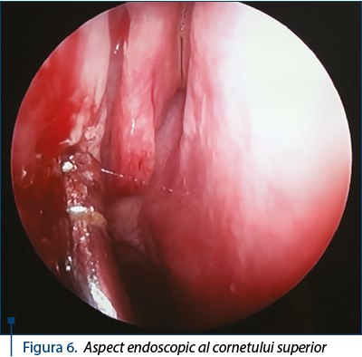 Figura 6. Aspect endoscopic al cornetului superior