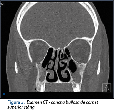 Figura 3. Examen CT - concha bullosa de cornet superior stâng