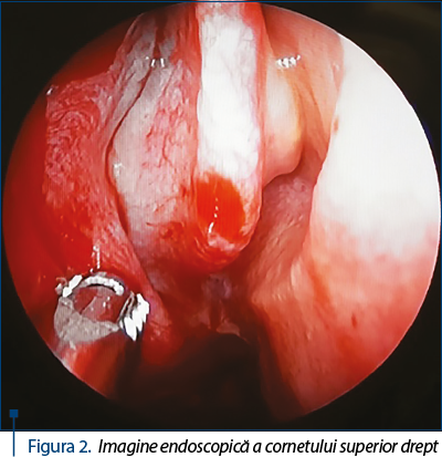 Figura 2. Imagine endoscopică a cornetului superior drept