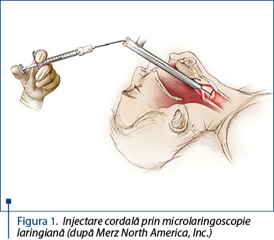 Figura 1. Injectare cordală prin microlaringoscopie laringiană (după Merz North America, Inc.)