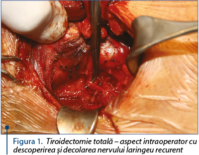 Figura 1. Tiroidectomie totală – aspect intraoperator cu descoperirea şi decolarea nervului laringeu recurent