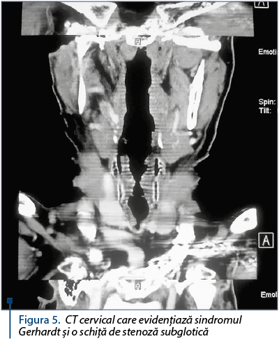 Figura 5. CT cervical care evidenţiază sindromul Gerhardt şi o schiţă de stenoză subglotică