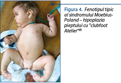 Figura 4. Fenotipul tipic al sindromului Moebius-Poland – hipoplazia pieptului cu "clubfoot Atelier"(8) 