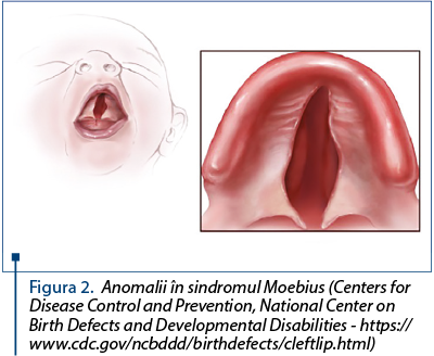 Figura 2. Anomalii în sindromul Moebius (Centers for Disease Control and Prevention, National Center on Birth Defects and Developmental Disabilities - https://www.cdc.gov/ncbddd/birthdefects/cleftlip.html)