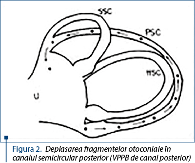 Figura 2. Deplasarea fragmentelor otoconiale în canalul semicircular posterior (VPPB de canal posterior)