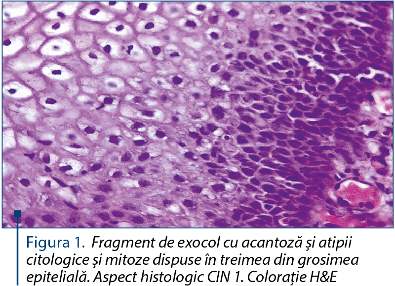 Figura 1. Fragment de exocol cu acantoză şi atipii citologice şi mitoze dispuse în treimea din grosimea epitelială. Aspect histologic CIN 1. Coloraţie H&E