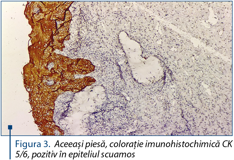Figura 3. Aceeaşi piesă, coloraţie imunohistochimică CK 5/6, pozitiv în epiteliul scuamos