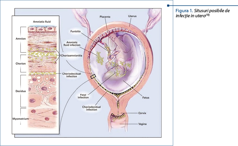 Figura 1.Situsuri posibile de infecţie in utero(10)