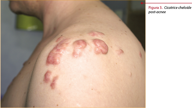 Figura 3. Cicatrice cheloide post-acnee