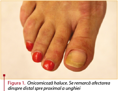 Figura 1. Onicomicoză haluce. Se remarcă afectarea dinspre distal spre proximal a unghiei
