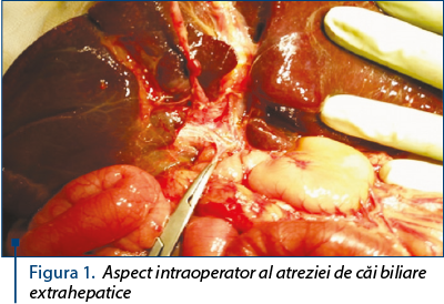 Figura 1. Aspect intraoperator al atreziei de căi biliare extrahepatice