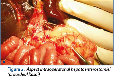 Figura 2. Aspect intraoperator al hepatoenterostomiei (procedeul Kasai)