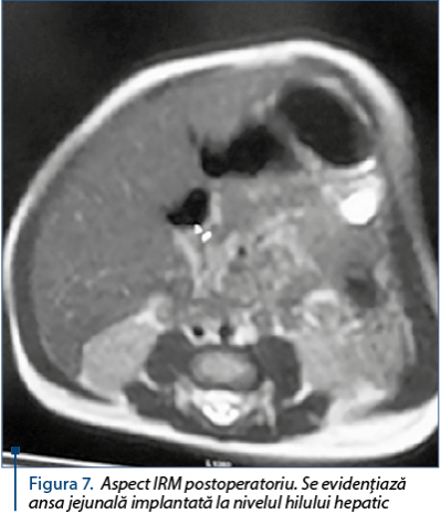 Figura 7. Aspect IRM postoperatoriu. Se evidenţiază ansa jejunală implantată la nivelul hilului hepa