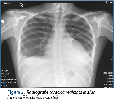 Figura 2. Radiografie toracică realizată în ziua internării în clinica noastră