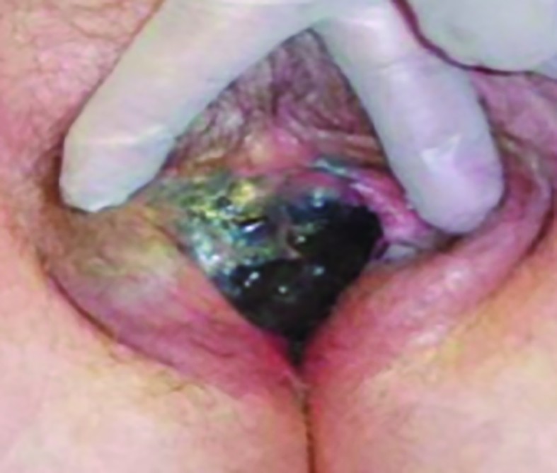 Figure 2. Vulvar melanoma (ulcerated) - source: http://es.slideshare.net/Pamizu/patologas-del-aparato-reprodutor-femenino 