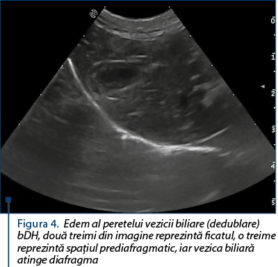 Figura 4. Edem al peretelui vezicii biliare (dedublare) bDH, două treimi din imagine reprezintă ficatul, o treime reprezintă spaţiul prediafragmatic, iar vezica biliară atinge diafragma