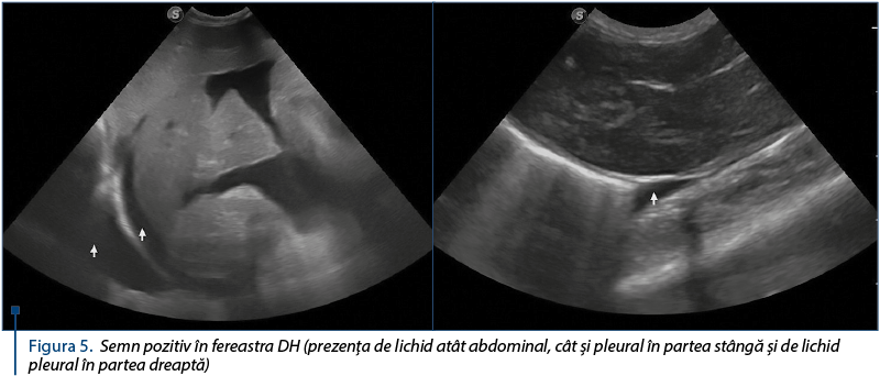 Figura 5. Semn pozitiv în fereastra DH (prezenţa de lichid atât abdominal, cât şi pleural în partea stângă şi de lichid pleural în partea dreaptă)