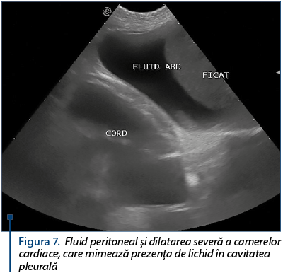Figura 7. Fluid peritoneal şi dilatarea severă a camerelor cardiace, care mimează prezenţa de lichid în cavitatea pleurală