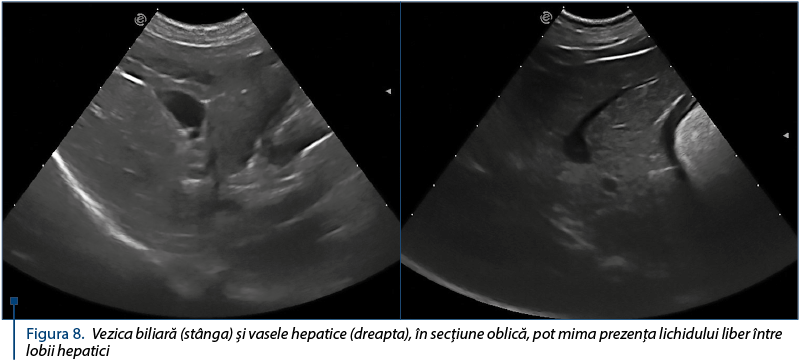 Figura 8. Vezica biliară (stânga) şi vasele hepatice (dreapta), în secţiune oblică, pot mima prezenţa lichidului liber între lobii hepatici
