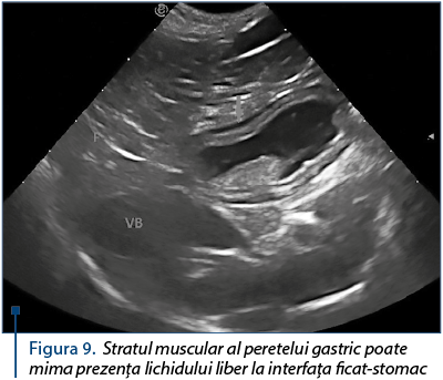 Figura 9. Stratul muscular al peretelui gastric poate mima prezenţa lichidului liber la interfaţa ficat-stomac