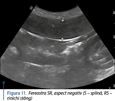 Figura 11. Fereastra SR, aspect negativ (S – splină, RS – rinichi stâng)