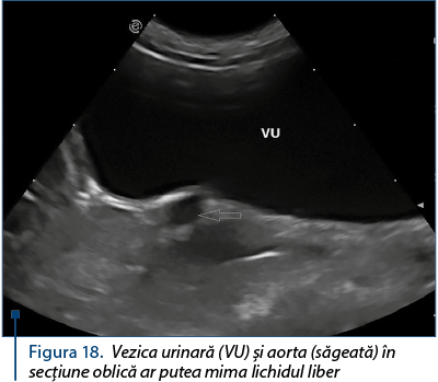 Figura 18. Vezica urinară (VU) şi aorta (săgeată) în secţiune oblică ar putea mima lichidul liber