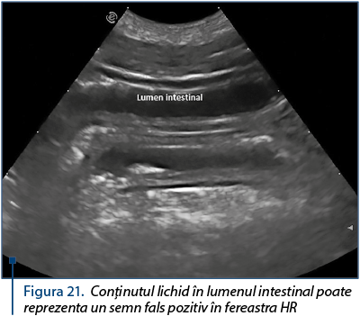 Figura 21. Conţinutul lichid în lumenul intestinal poate reprezenta un semn fals pozitiv în fereastra HR