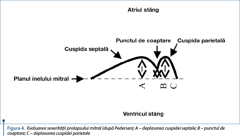 Figura 4. Evaluarea severităţii prolapsului mitral (după Pedersen); A – deplasarea cuspidei septale; B – punctul de coaptare; C – deplasarea cuspidei parietale