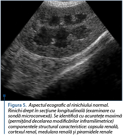 Figura 5. Aspectul ecografic al rinichiului normal. Rinichi drept în secţiune longitudinală (examinare cu sondă microconvexă). Se identifică cu acurateţe maximă (permiţând decelarea modificărilor inframilimetrice) componentele structural caracteristice: capsula renală, cortexul renal, medulara renală şi piramidele renale
