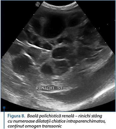 Figura 8. Boală polichistică renală – rinichi stâng cu numeroase dilataţii chistice intraparenchimatos, conţinut omogen transsonic