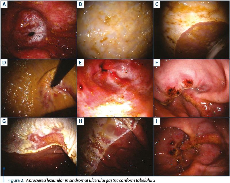 Figura 2. Aprecierea leziunilor în sindromul ulcerului gastric conform tabelului 3