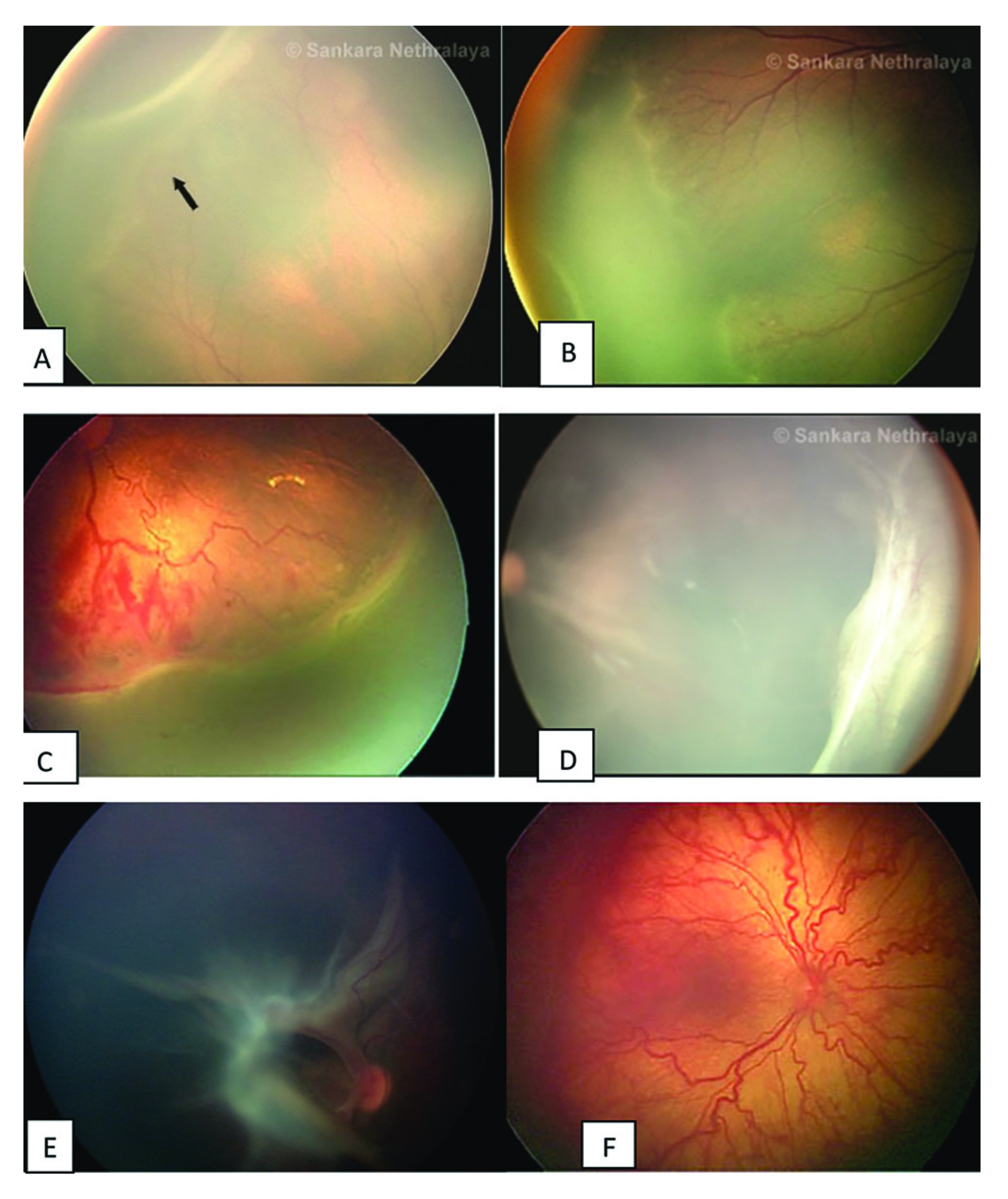 Figure 1. (A) Stage 1: Demarcation line. (B) Stage 2: Ridge. (C) Stage 3: Ridge with extraretinal fibrovascular proliferation. (D) Stage 4A: extrafoveal retinal detachment. (E) Stage 4B: fovea involving retinal detachment. (F) Plus disease with dilated and tortuous retinal vessels.  Reproduced with permission from Committee for the Classification of Retinopathy of Prematurity. An international classification of retinopaty of prematurity(2)