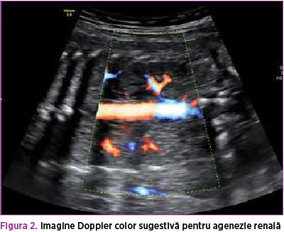 Figura 2. Imagine Doppler color sugestivă pentru agenezie renală