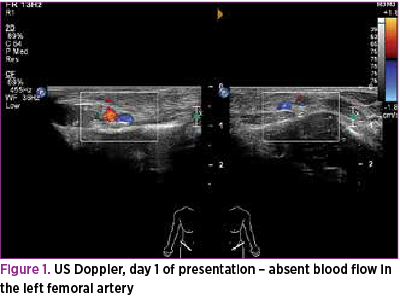 Figure 1. US Doppler, day 1 of presentation – absent blood flow in the left femoral artery