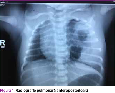 Figura 1. Radiografie pulmonară anteroposterioară