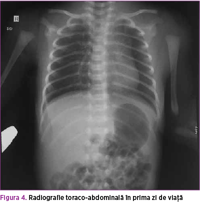 Figura 4. Radiografie toraco-abdominală în prima zi de viaţă