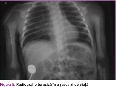 Figura 5. Radiografie toracică în a şasea zi de viaţă