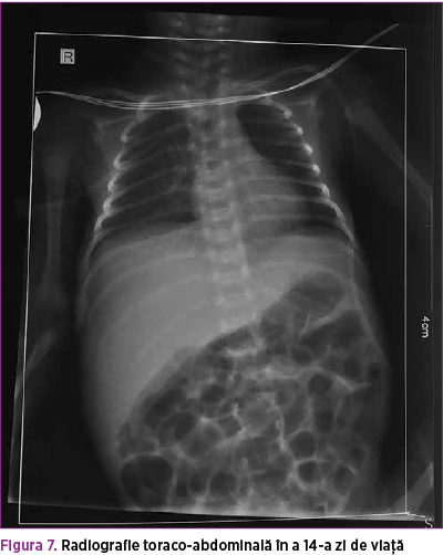 Figura 7. Radiografie toraco-abdominală în a 14-a zi de viaţă