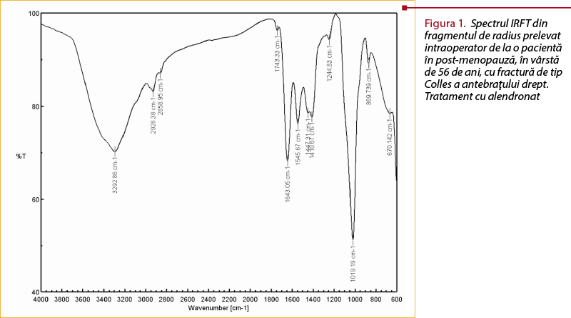 Figura 1. Spectrul IRFT din fragmentul de radius prelevat intraoperator de la o pacientă în post-menopauză, în vârstă de 56 de ani, cu fractură de tip Colles a antebraţului drept. Tratament cu alendronat