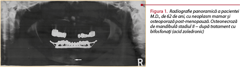 Figura 1. Radiografie panoramică a pacientei M.D., de 62 de ani, cu neoplasm mamar şi osteoporoză post-menopauză. Osteonecroză de mandibulă stadiul II − după tratament cu bifosfonaţi (acid zoledronic)