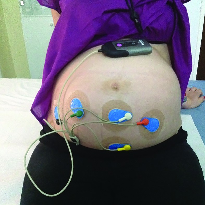 Figura 3. Holter fetal Monica AN 25, cu dispunerea abdominală a electrozilor