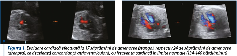 Figura 1. Evaluare cardiacă efectuată la 17 săptămâni de amenoree (stânga), respectiv 24 de săptămâni de amenoree  (dreapta), ce decelează concordanţă atrioventriculară, cu frecvenţa cardiacă în limite normale (134-140 bătăi/minut)
