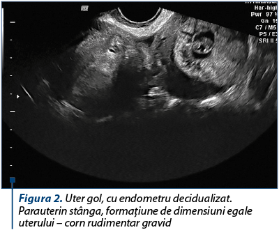Figura 2. Uter gol, cu endometru decidualizat.  Para­ute­rin stânga, formaţiune de dimensiuni egale uterului – corn rudimentar gravid