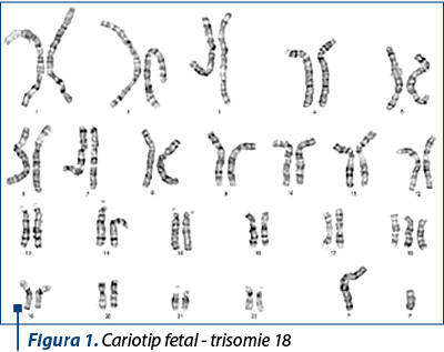 Figura 1. Cariotip fetal - trisomie 18