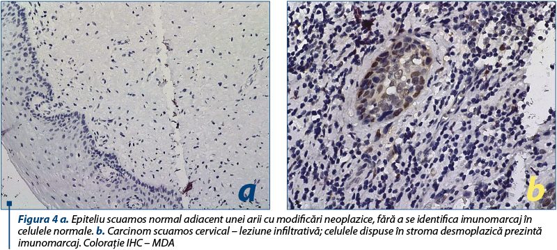 Figura 4 a. Epiteliu scuamos normal adiacent unei arii cu modificări neoplazice, fără a se identifica imunomarcaj în celulele normale. b. Carcinom scuamos cervical – leziune infiltrativă; celulele dispuse în stroma desmoplazică prezintă imunomarcaj. Coloraţie IHC – MDA