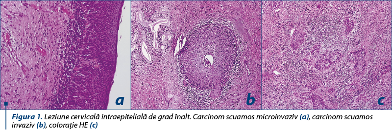 Figura 1. Leziune cervicală intraepitelială de grad înalt. Carcinom scuamos microinvaziv (a), carcinom scuamos invaziv (b), coloraţie HE (c)