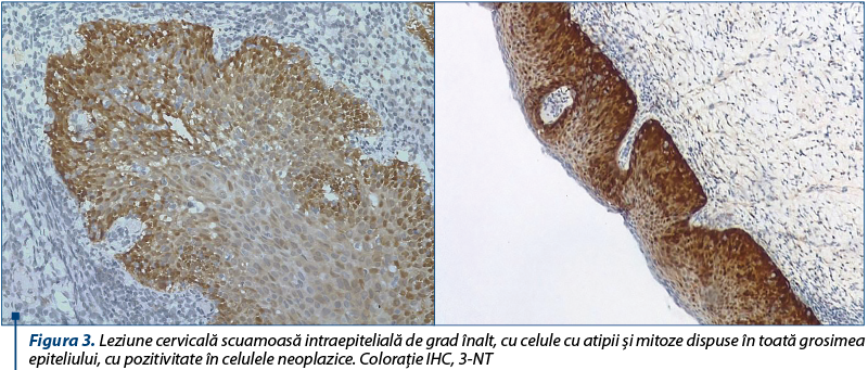 Figura 3. Leziune cervicală scuamoasă intraepitelială de grad înalt, cu celule cu atipii şi mitoze dispuse în toată grosimea epiteliului, cu pozitivitate în celulele neoplazice. Coloraţie IHC, 3-NT
