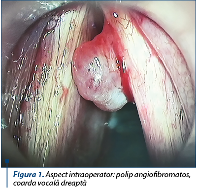 Figura 1. Aspect intraoperator polip angiofibromatos, coarda vocală dreaptă